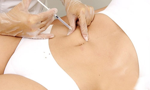 Mesoterapia